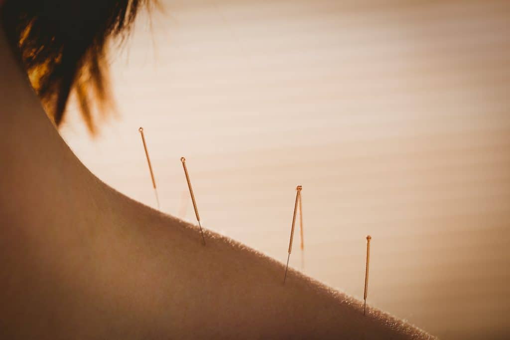 Acupuncture Assurance maladie