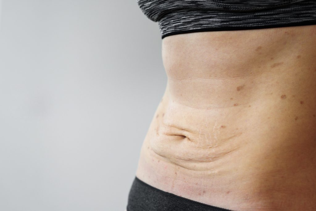 Abdominoplastie