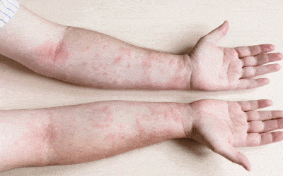 Été: quelles sont les maladies de peau les plus récurrentes?